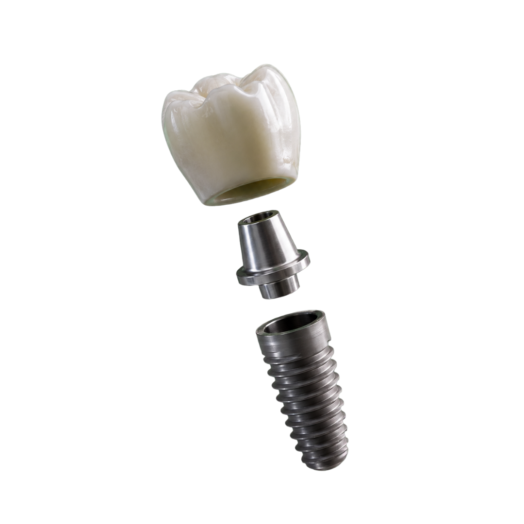 Implante dentário — coroa, abutment e parafuso de titânio